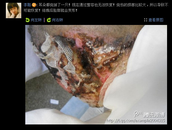  合肥少女毁容案 追踪:周岩数次试图咬舌自尽(图